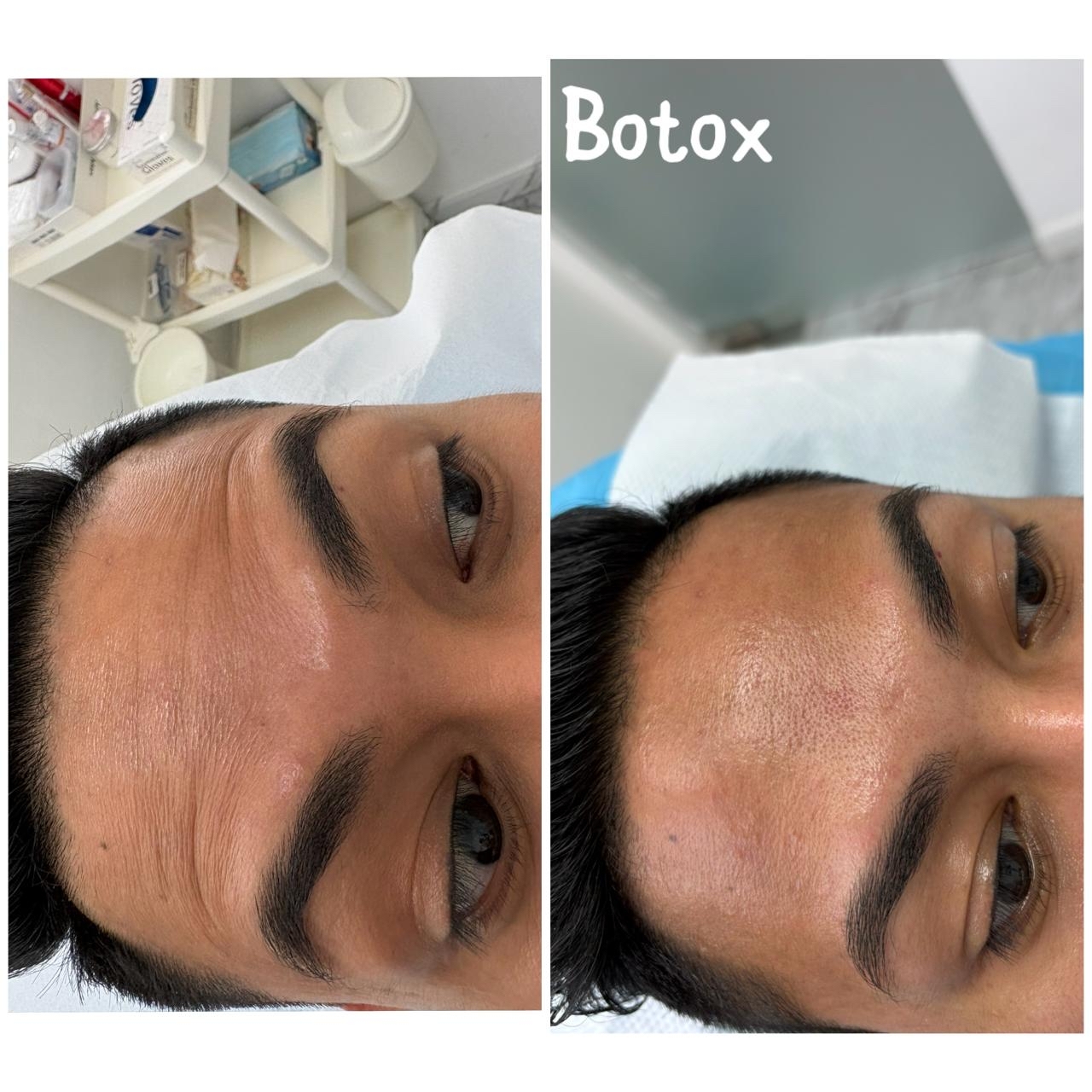 Anti-Wrinkle (Botox) — before and after