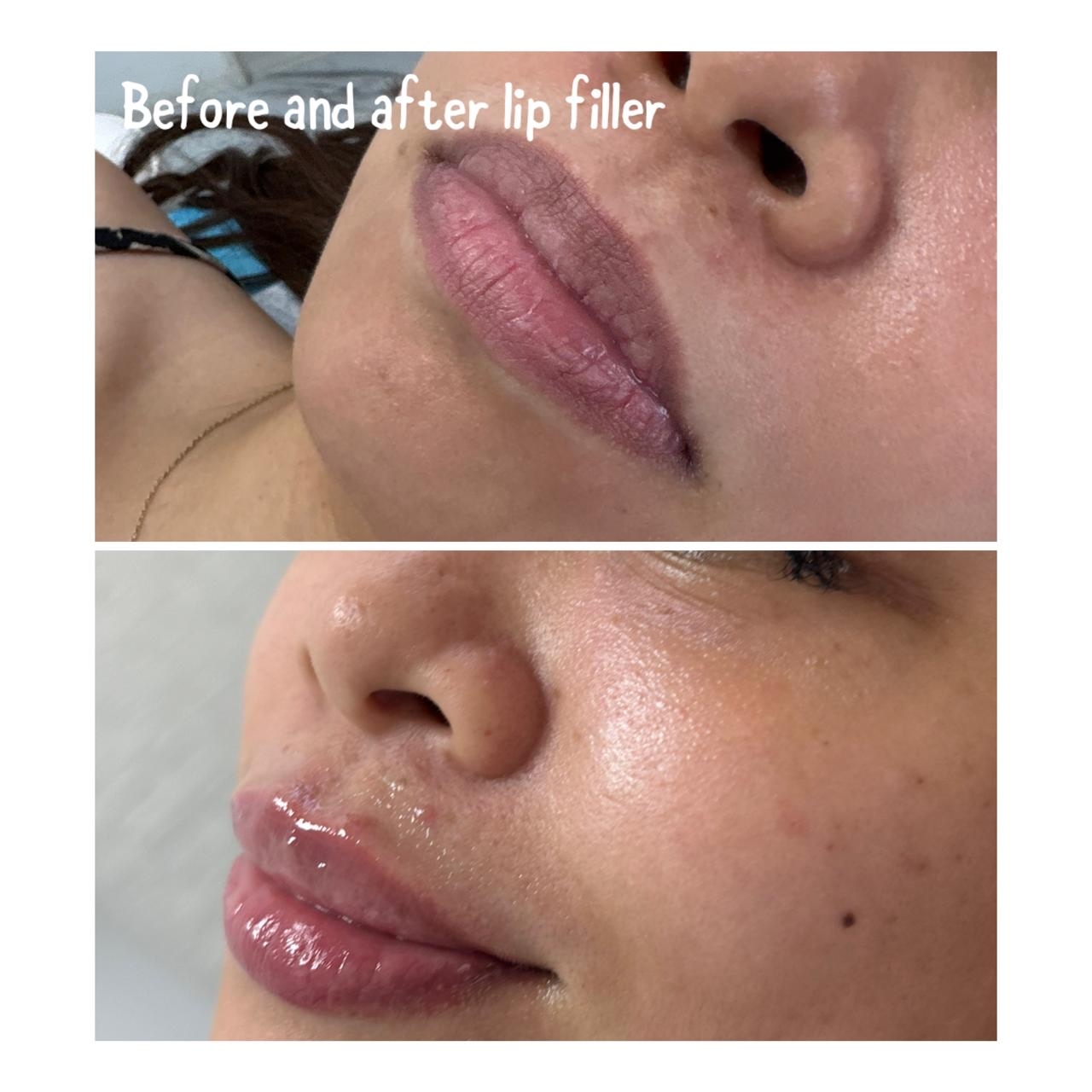 Lip Filler — before and after