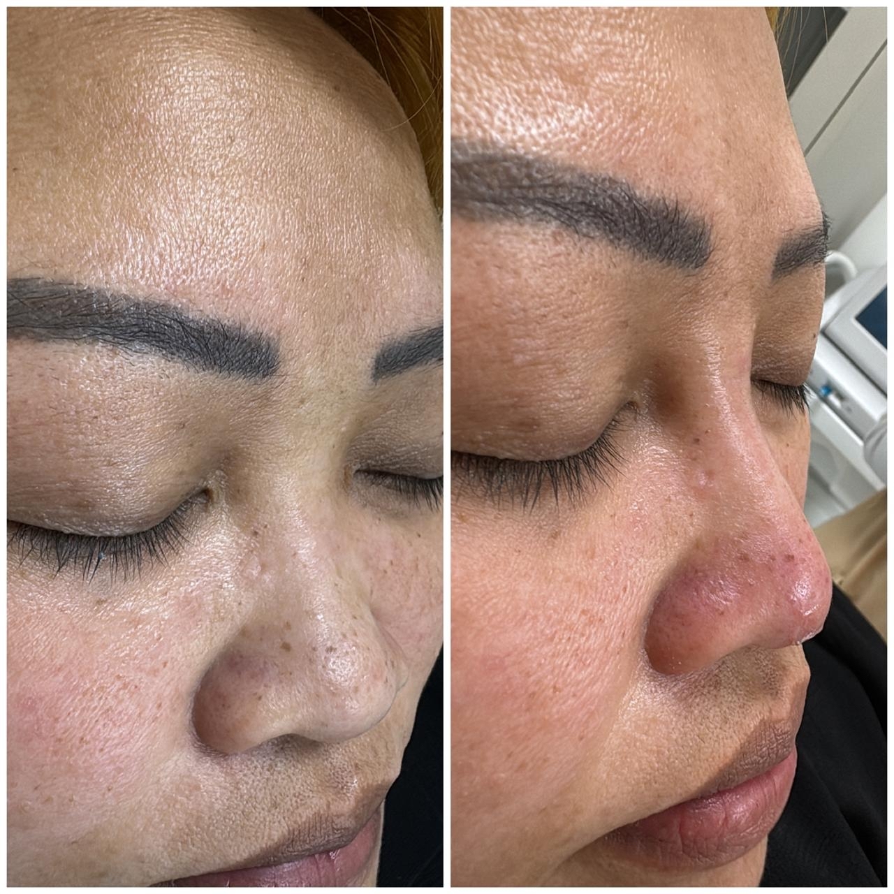 Non-Surgical Nose Reshaping — before and after